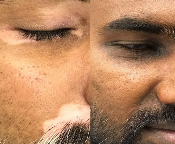 Scar Camouflage in Baltimore area | Glow Cosmetic Tattoo Studio