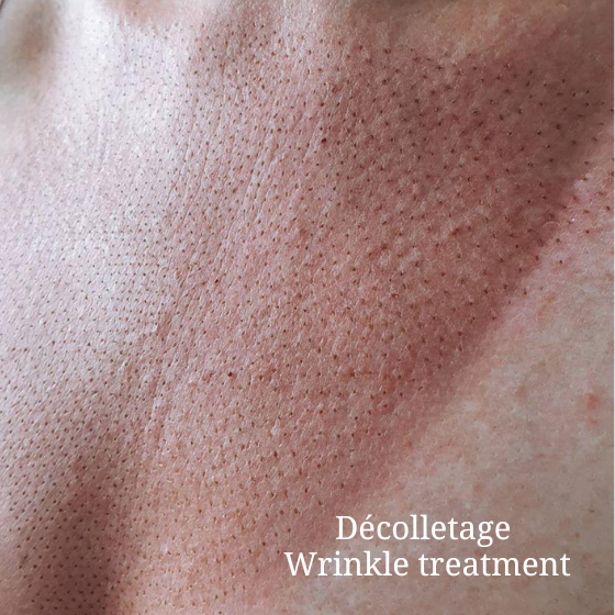Décolletage Skin Tightening Sydney Décolletage skin tightening and wrinkle treatment in Sydney