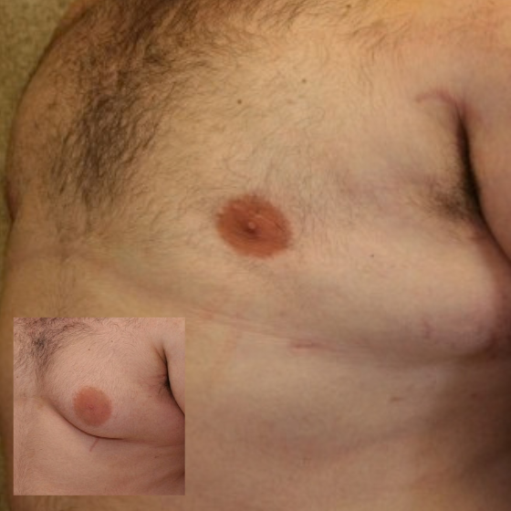 Male Chest Surgery Scar Camouflage Male chest surgery scar camouflage and areola tattoo Sydney CBD