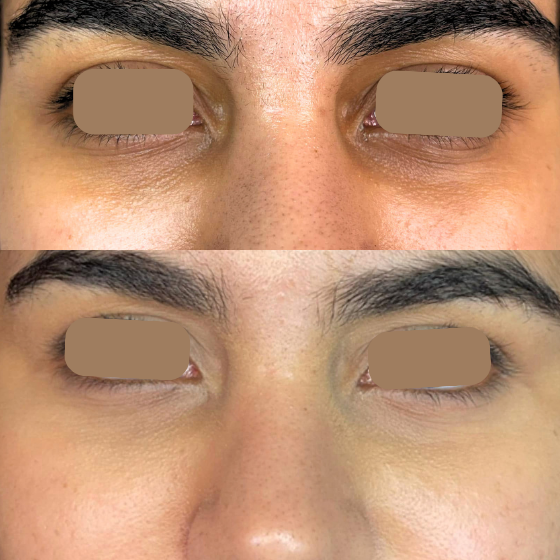 Under-Eye Dark Circle Camouflage Sydney Under-eye dark circle camouflage cosmetic tattoo Sydney
