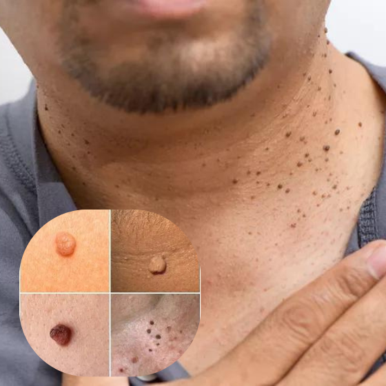 Plasma treatment for selected minor skin irregularities Minor skin irregularities treatment in Sydney