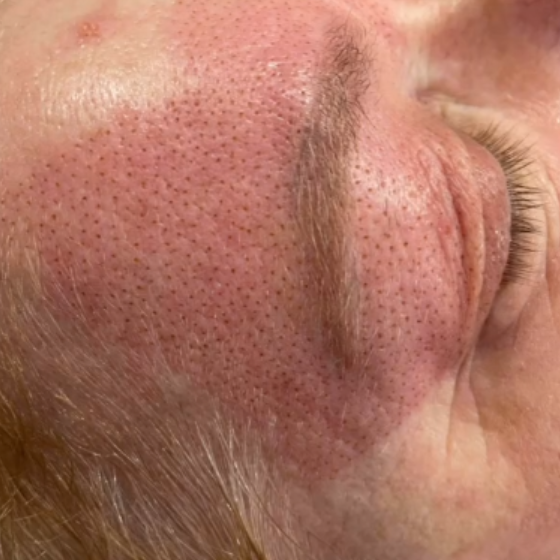 Plasma Brow Lift Sydney Plasma fibroblast brow lift treatment in Sydney